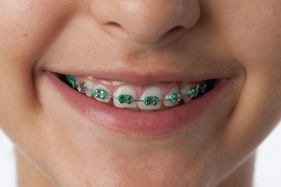 Say Goodbye to Braces Blues: Braces for Teens and How To Take Care of Them With Denterity Essentials