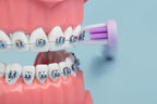 Braces Buddies Starter Kit