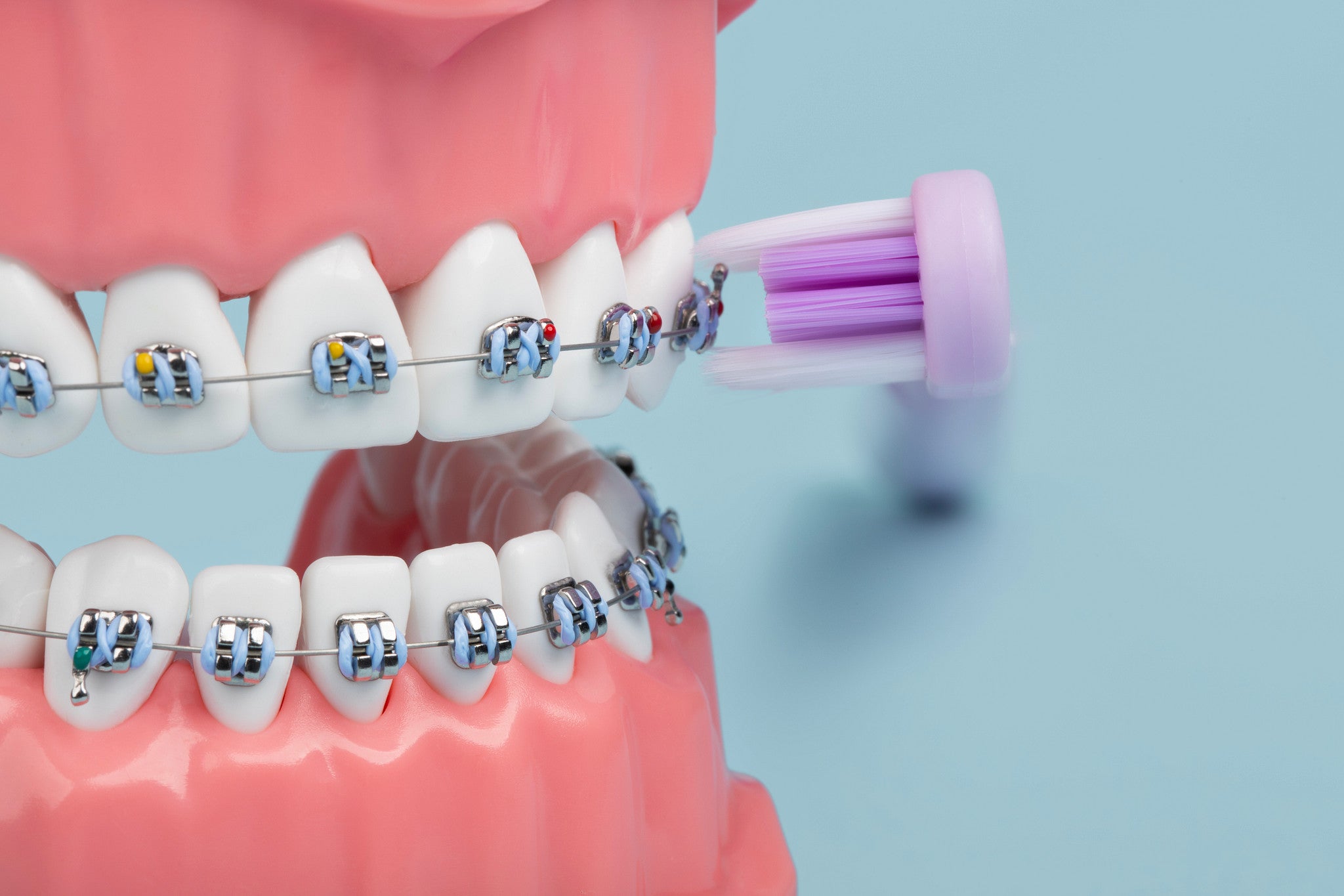 Braces Buddies Starter Kit