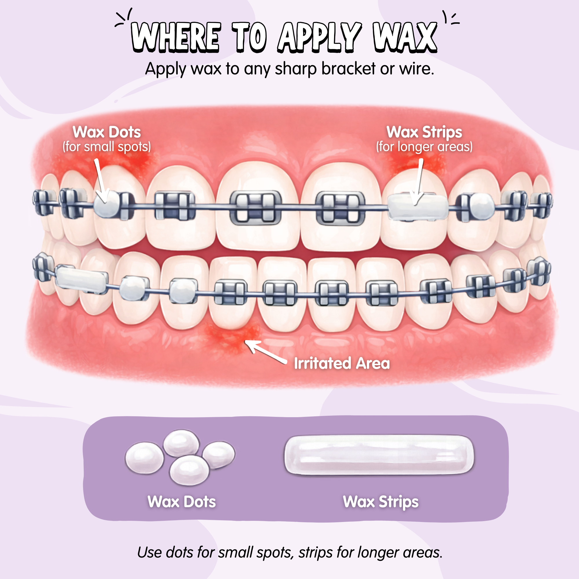 Braces Comfort Wax Kit